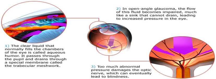 Causes of Glaucoma