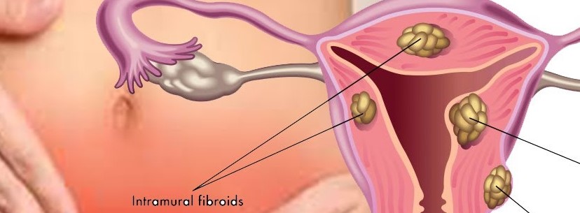 Uterine Fibroids