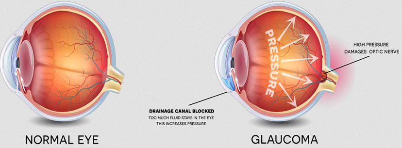 What is Glaucoma